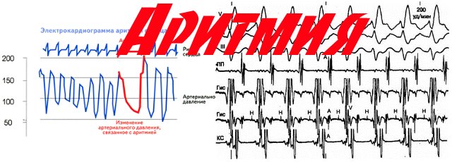 график работы сердца при аритмии